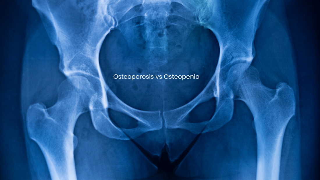 Osteoporosis vs. Osteopenia: What's the Difference and Why It Matters