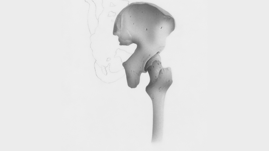 What Is Osteoporosis? The Silent Disease Explained